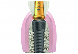 The Concept of “Platform Switching” and Peri-Implant Bone Stability