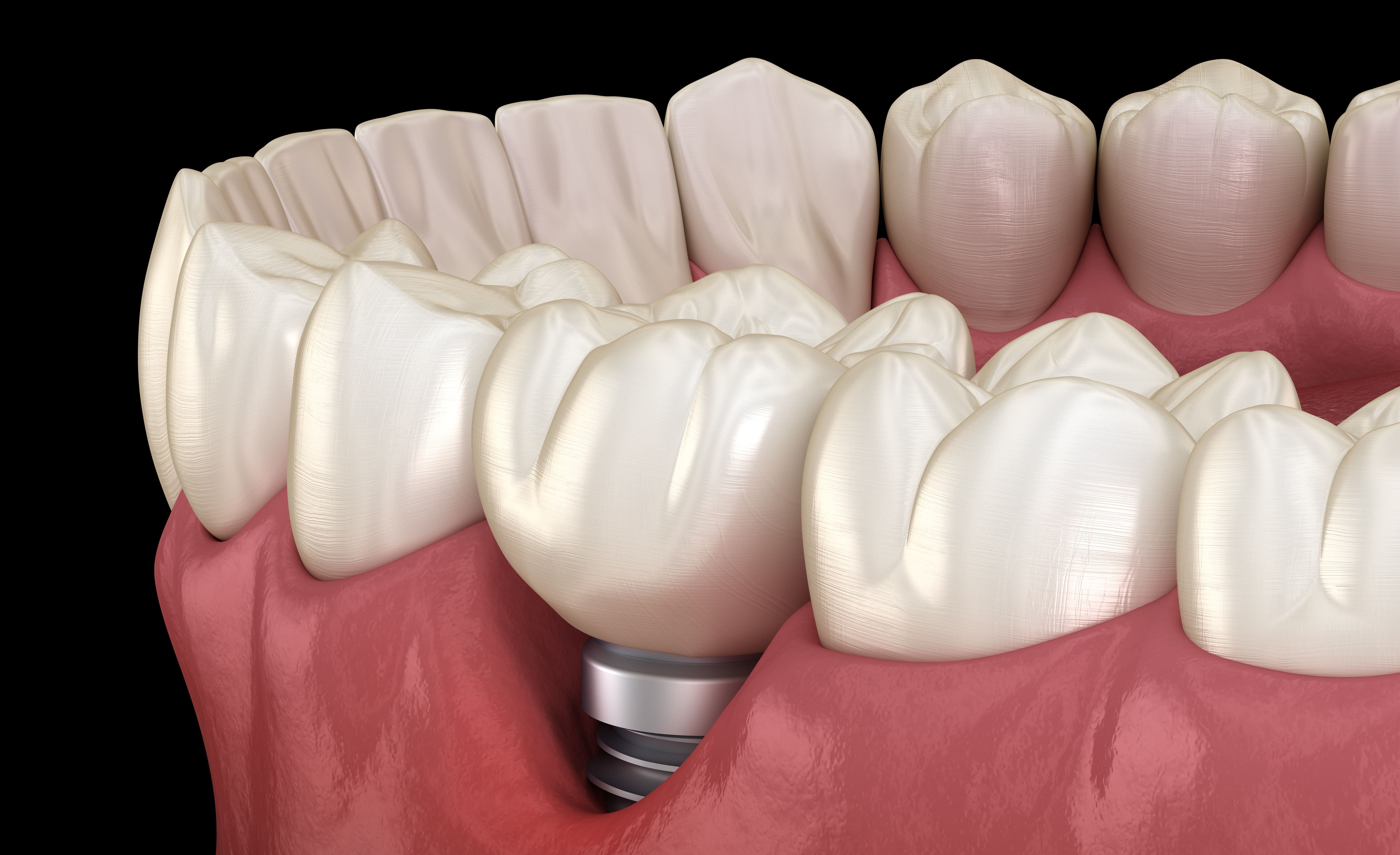 Peri-implantitis 2/3 : epidemiological data, various means of diagnosis and different risk factors.