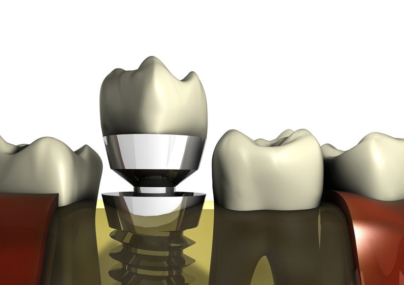On the role of surface properties for implant fixation: From finite element modeling to in vivo studies