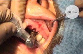Flapless implant placement