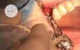 Clinical case: Sinus lift and Summers procedure with a piezosurgery
