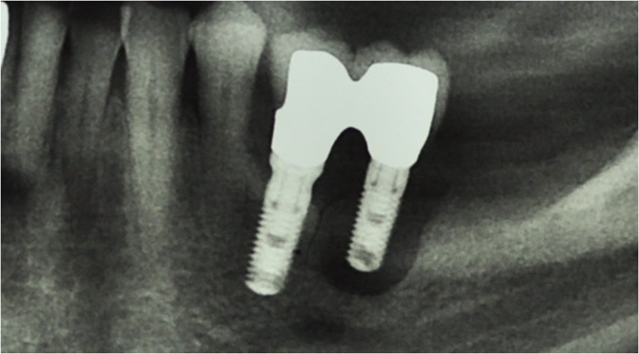 Peri-implantitis and periodontitis. Experimental and clinical studies