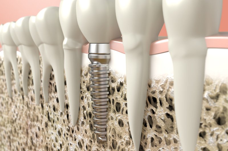 On minimally invasive approaches to sinus lift procedures