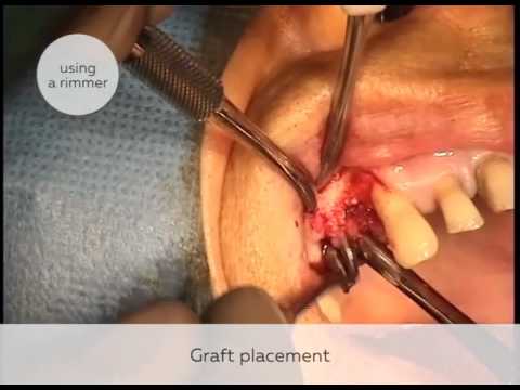Single filling of an alveolus