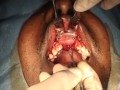 Clinical case: Bone graft recovery