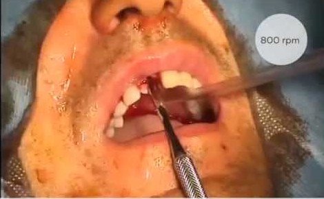 Peri implant fulfillment