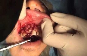 Implant placement with big fenestration