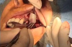 Broken implant removal with Piezosurgery