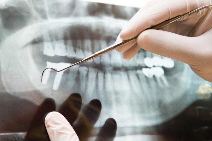 On tooth movements and associated tissue alterations related to edentulous areas and bone defects