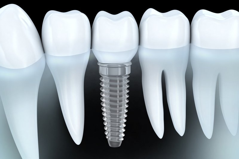How to identify an unknown implant?