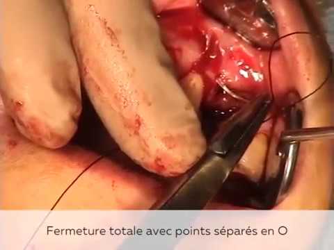 Implant placement with bone graft apposition