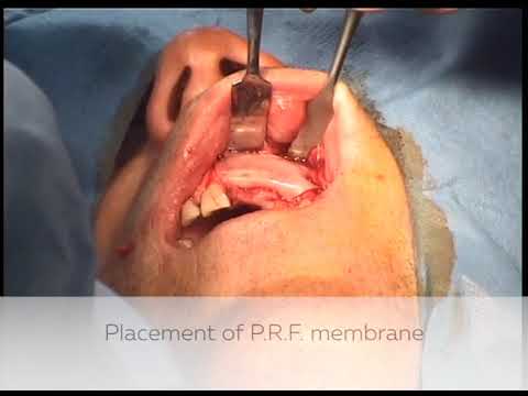 Implant with bone graft strengthened with P.R.P.