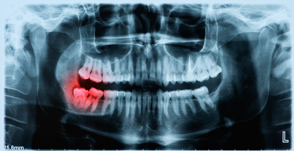 Periodontitis in twins: smoking, microbiological and immunological aspects