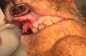 Implant with vestibular bone graft