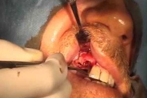 Implant placement with bone expansion and abutments