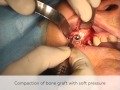 Clinical case: Sinus lift with lateral window