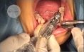 Clinical case: Implant placement after bone graft apposition and recovery with autogenous bone Clinical case: Implant placement after bone graft apposition and recovery with autogenous bone