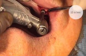 Placement of multiple implants after sinus lift