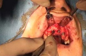 Implant with fenestration