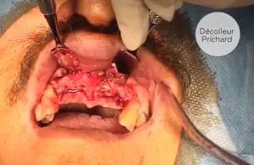 Extractions and delayed implantations
